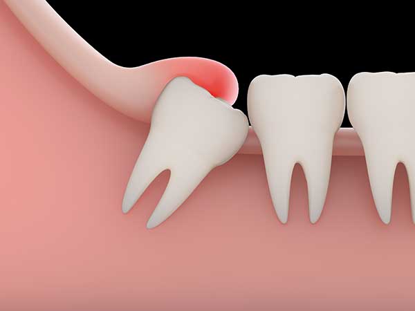 Wisdom Teeth Removal - Palmerston Dental Surgery